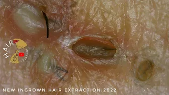 Ingrown Hair blackhead hair extraction compilation 2022 | Satisfying 200x ZOOM ingrown extraction