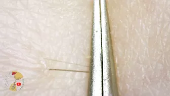 Ingrown Hair blackhead hair extraction compilation 2022 | Satisfying 200x ZOOM ingrown extraction