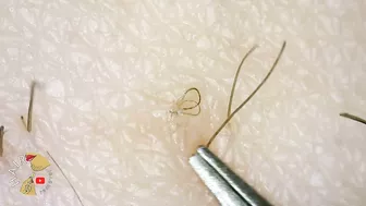 Ingrown Hair blackhead hair extraction compilation 2022 | Satisfying 200x ZOOM ingrown extraction