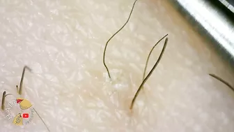 Ingrown Hair blackhead hair extraction compilation 2022 | Satisfying 200x ZOOM ingrown extraction