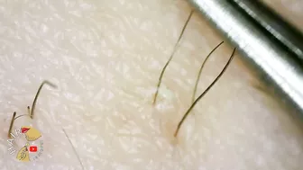 Ingrown Hair blackhead hair extraction compilation 2022 | Satisfying 200x ZOOM ingrown extraction