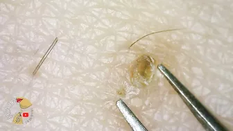 Ingrown Hair blackhead hair extraction compilation 2022 | Satisfying 200x ZOOM ingrown extraction