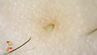 Ingrown Hair blackhead hair extraction compilation 2022 | Satisfying 200x ZOOM ingrown extraction