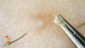 Ingrown Hair blackhead hair extraction compilation 2022 | Satisfying 200x ZOOM ingrown extraction