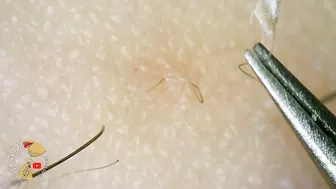 Ingrown Hair blackhead hair extraction compilation 2022 | Satisfying 200x ZOOM ingrown extraction