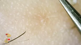 Ingrown Hair blackhead hair extraction compilation 2022 | Satisfying 200x ZOOM ingrown extraction