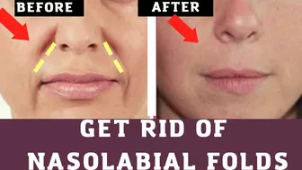 How to Remove Nasolabial folds |Smile lines  Face Yoga & Massage