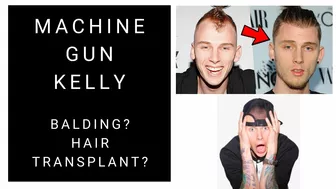 Did Machine Gun Kelly have a Hair Transplant? (Celebrity Hair Transplant Surgeon Answers)