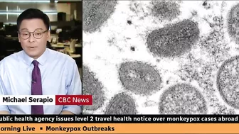 Canadian health officials issue travel notice over monkeypox