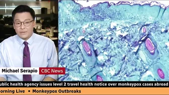 Canadian health officials issue travel notice over monkeypox