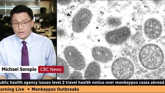 Canadian health officials issue travel notice over monkeypox