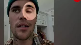 Justin Bieber reveals facial paralysis on Instagram Video