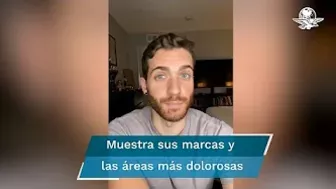 Joven narra en TikTok su horrible experiencia luego de contraer viruela del mono