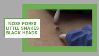 A compilation of nose pores, little snakes and black heads | Dr. Derm