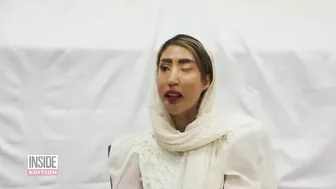 Acid Attack Survivors Model for Fashion Line