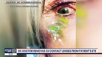 Newport Beach doctor removes '23 contact lenses' from patient's eye