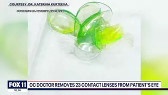 Newport Beach doctor removes '23 contact lenses' from patient's eye