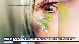 Newport Beach doctor removes '23 contact lenses' from patient's eye