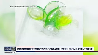 Newport Beach doctor removes '23 contact lenses' from patient's eye