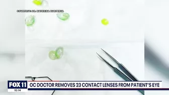 Newport Beach doctor removes '23 contact lenses' from patient's eye