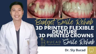 DIGITAL FLEXIBLE DENTURE WITH 3D PRINTED CROWNS