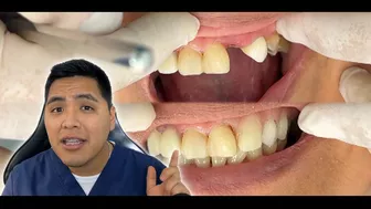 Como RECUPERAR DIENTES con una protesis invisible #viral #shorts #short #protesisdental