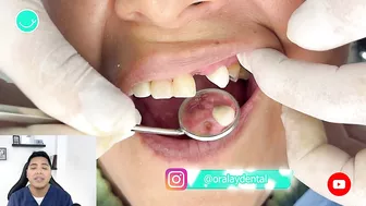 Como RECUPERAR DIENTES con una protesis invisible #viral #shorts #short #protesisdental