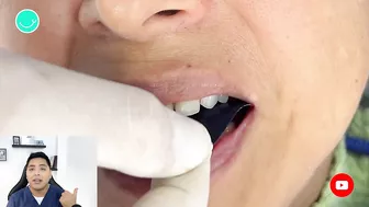 Como RECUPERAR DIENTES con una protesis invisible #viral #shorts #short #protesisdental