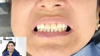 Como RECUPERAR DIENTES con una protesis invisible #viral #shorts #short #protesisdental