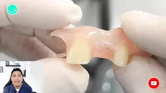 Como RECUPERAR DIENTES con una protesis invisible #viral #shorts #short #protesisdental