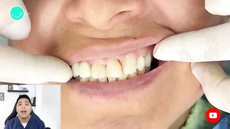 Como RECUPERAR DIENTES con una protesis invisible #viral #shorts #short #protesisdental