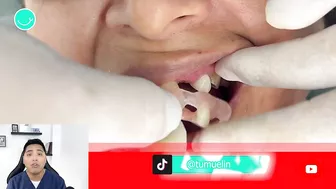 Como RECUPERAR DIENTES con una protesis invisible #viral #shorts #short #protesisdental