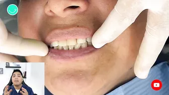 Como RECUPERAR DIENTES con una protesis invisible #viral #shorts #short #protesisdental