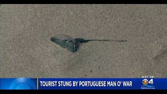 South Beach Tourist Stung By Portuguese Man O' War