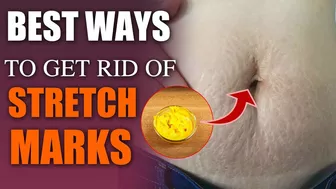 Home Remedy For Stretch Marks | How To Get Rid Of Stretch Marks | How to Remove Stretch Marks