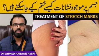 Treatment of Stretch Marks | Dr Ahmed Haroon Amin | Health Matters