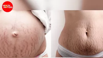 Treatment of Stretch Marks | Dr Ahmed Haroon Amin | Health Matters