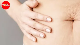 Treatment of Stretch Marks | Dr Ahmed Haroon Amin | Health Matters