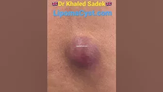 Weekly Skin Compilation Dr Khaled Sadek #acne #blackheadremoval #drkhsledsadek LIPOMACYST.com