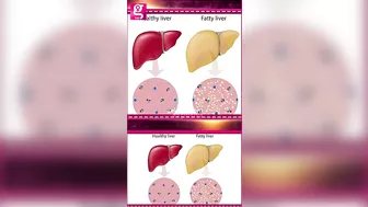 Fatty Liver-அ எப்படி Cure பண்றது? - Siddha Dr. B Yoga Vidya | PCOD #healthcaretips #galattapink