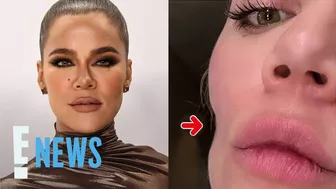 Khloé Kardashian Reveals Skin Cancer Removal Left Face Indentation | E! News