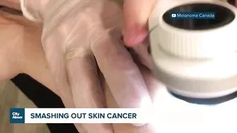 Celebrity fundraiser hoping to help end skin cancer