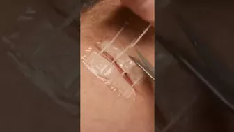 The Best Wound Stretching Without Pain !