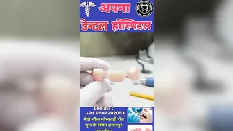 flexible denture . दांत कैसे बनता है।।#dentaltreatment #apna_dental_hospital