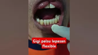 #flexible #gigipalsu #dentures