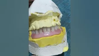 Flexible partial Denture Ready For Try In ????????????#dentures #dentalartbyhaider