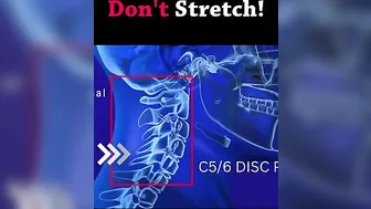 Stop Stretching Neck For Cervical Dizziness/Pain #shorts #youtubeshorts #chiropractor